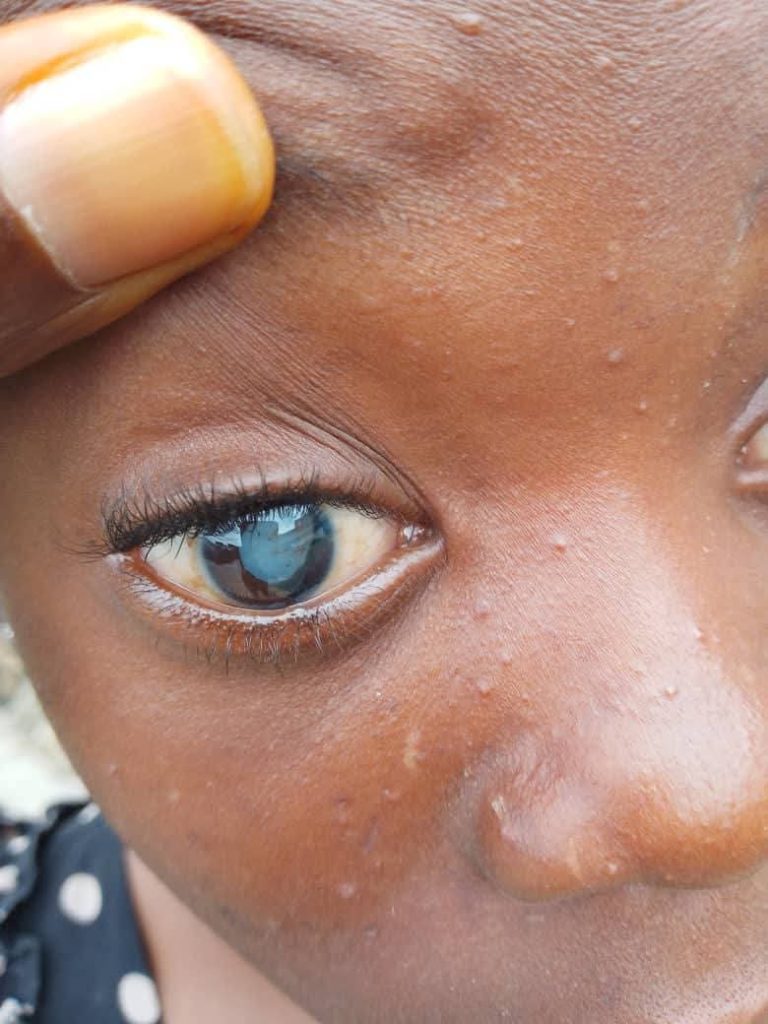 13- year-old girl disfigured by guardian in Imo to undergo surgery